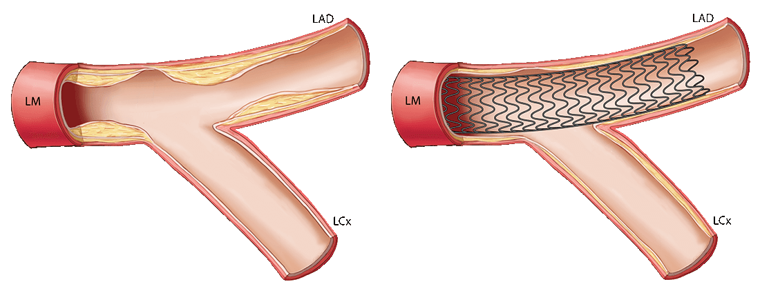 Stent
